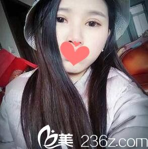 眼皮一單一雙好難看，找韓國BCI整形外科金秉哲做雙眼皮+開眼角后讓我重拾自信