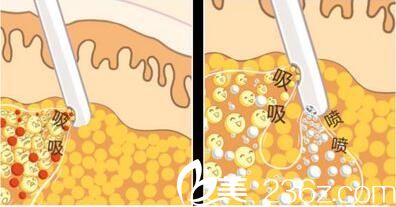 韓國張益秀整形外科張益秀抽脂塑形 韓國張益秀整形外科張益秀抽脂塑形