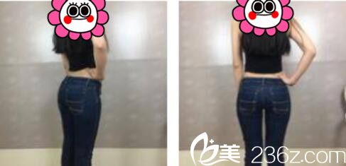 韓國張益秀整形外科張益秀抽脂瘦小腿真人案例術(shù)前照 韓國張益秀整形外科張益秀抽脂瘦小腿真人案例術(shù)前照