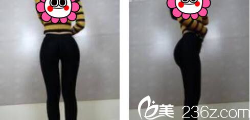 韓國張益秀整形外科張益秀抽脂瘦小腿真人案例術(shù)后十五天 韓國張益秀整形外科張益秀抽脂瘦小腿真人案例術(shù)后十五天