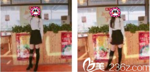 韓國張益秀整形外科張益秀抽脂瘦小腿真人案例術(shù)后一個(gè)月 韓國張益秀整形外科張益秀抽脂瘦小腿真人案例術(shù)后一個(gè)月