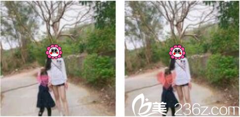 韓國張益秀整形外科張益秀抽脂瘦小腿真人案例術(shù)后兩個(gè)月 韓國張益秀整形外科張益秀抽脂瘦小腿真人案例術(shù)后兩個(gè)月