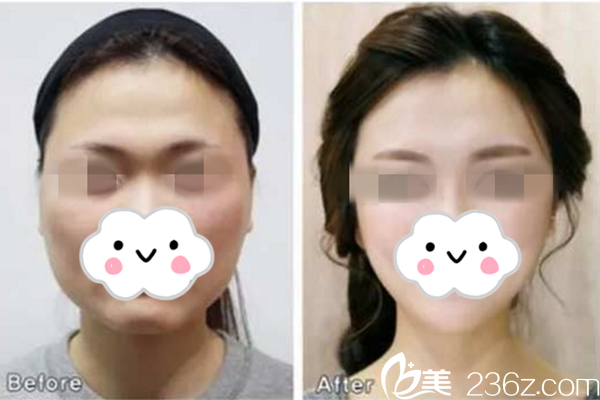 金柱奉面部輪廓整形真人案例 金柱奉面部輪廓整形真人案例