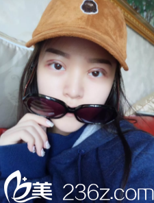 剛做完雙眼皮手術(shù)眼睛腫脹