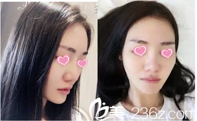 隆鼻前照片 隆鼻前照片