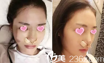 隆鼻后1天 隆鼻后1天