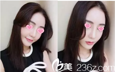 金榮洙院長隆鼻手術案例 金榮洙院長隆鼻手術案例