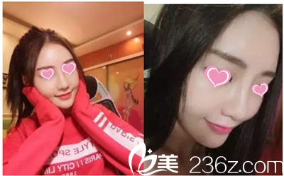 韓國雅佳整形醫(yī)院隆鼻手術案例 韓國雅佳整形醫(yī)院隆鼻手術案例