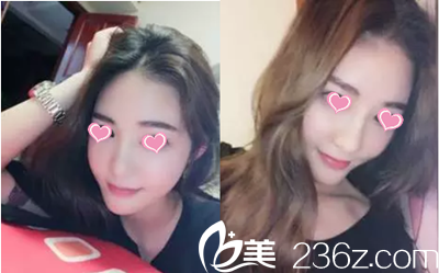 韓國雅佳整形醫(yī)院金榮洙做鼻子怎么樣？分享一組真人案例