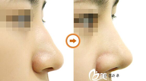 駝峰鼻矯正對(duì)比案例 駝峰鼻矯正對(duì)比案例
