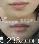 韓國Pomme breast整形外科下巴整形案例 韓國Pomme breast整形外科下巴整形案例