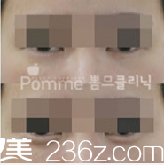 韓國Pomme breast整形外科臥蠶再造案例 韓國Pomme breast整形外科臥蠶再造案例