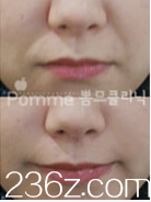 韓國Pomme breast整形外科去除法令紋案例 韓國Pomme breast整形外科去除法令紋案例