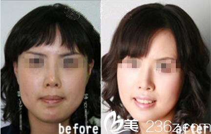 金鐘瑞下頜角真人前后對比展示