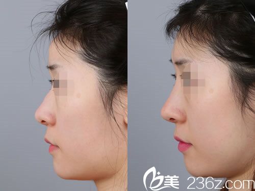 駝峰鼻矯正對比案例	