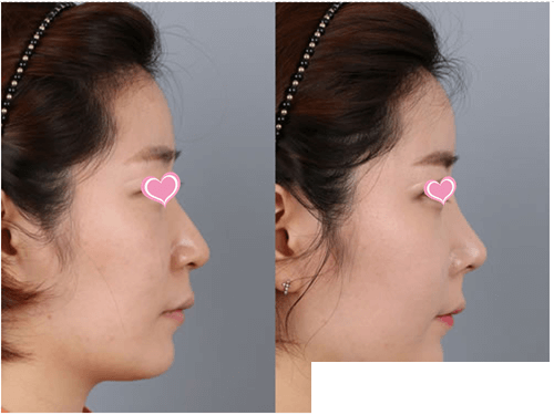 MULTI BEAUTY LINE鼻整形 箭頭鼻矯正