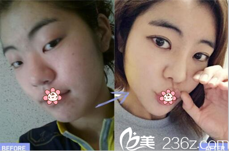 金陽洙院長雙眼皮案例 金陽洙院長雙眼皮案例