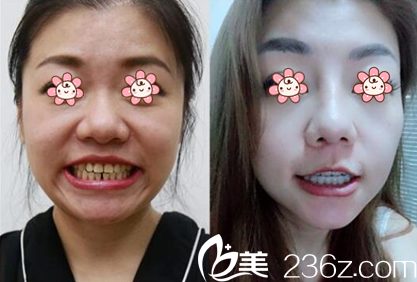 金元鎮(zhèn)院長牙齒矯正案例 金元鎮(zhèn)院長牙齒矯正案例