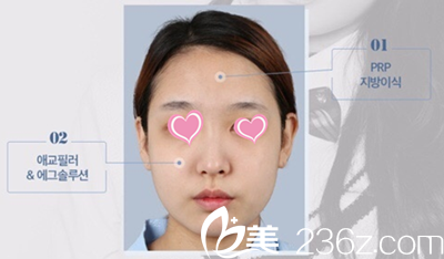 韓國(guó)自然主義整形醫(yī)院自體脂肪填充全臉手術(shù)案例 韓國(guó)自然主義整形醫(yī)院自體脂肪填充全臉手術(shù)案例