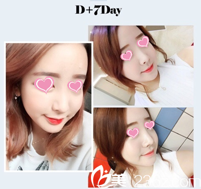 臥蠶14后天恢復(fù)效果 臥蠶14后天恢復(fù)效果