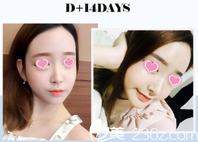 自體脂肪填充全臉一個(gè)月后 自體脂肪填充全臉一個(gè)月后