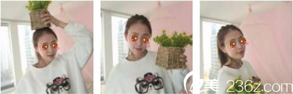 韓國Toxnfill整形外科宋仁權瘦臉除皺瘦真人案例術后十五天