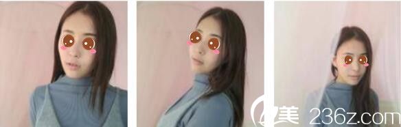 韓國Toxnfill整形外科宋仁權瘦臉除皺瘦真人案例術后一個月