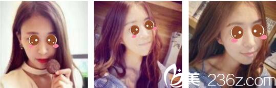 韓國Toxnfill整形外科宋仁權瘦臉除皺瘦真人案例術后兩個月