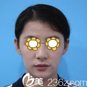 在韓國麗絲做鼻整形術前照 在韓國麗絲做鼻整形術前照