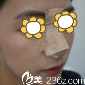 找金均泰做鼻整形術后第2天 找金均泰做鼻整形術后第2天