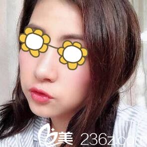 看看我找韓國麗絲整形外科金均泰做假體隆鼻效果，塌鼻子秒變小翹鼻！