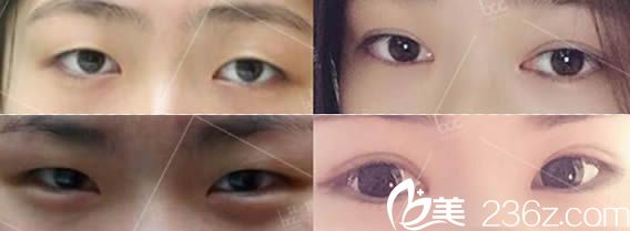 重慶聯(lián)合麗格王巖醫(yī)生雙眼皮案例效果圖 重慶聯(lián)合麗格王巖醫(yī)生雙眼皮案例效果圖