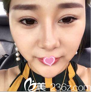 快看我在北京知音做這眼綜合手術(shù)價(jià)格適中效果好么