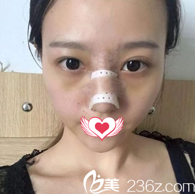 剛做完硅膠隆鼻鼻子腫脹