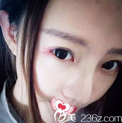 術(shù)后恢復(fù)16天鼻子消腫