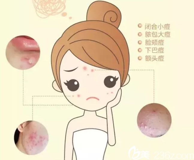 面部常見的痘痘類型 面部常見的痘痘類型