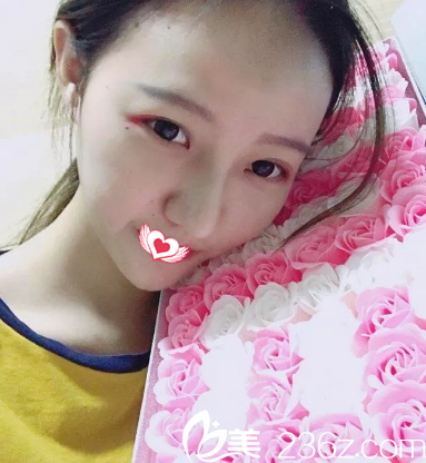 之前在唐山艾玲做雙眼皮效果自然無痕 后來又找謝艾玲院長做完假體隆鼻后擁有精致美鼻