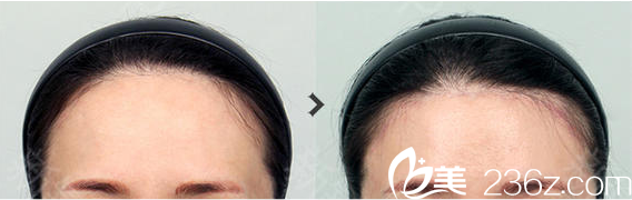 韓國TAILOR卓佑炫整形內(nèi)視鏡額頭提升術(shù)案例對比圖