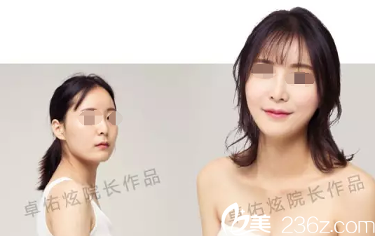 卓佑炫院長面部整形案例