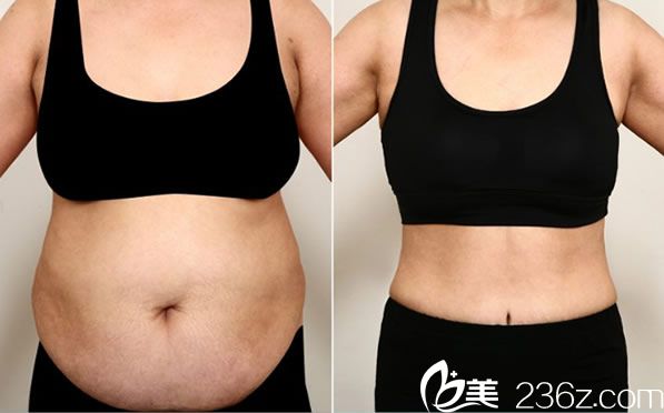 樸炳春院長全身吸脂<span style=