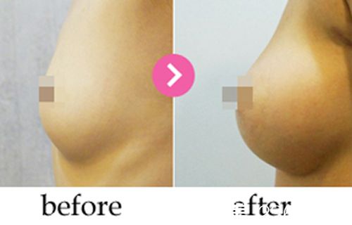 韓國德美特（mentor）整形醫(yī)院隆胸案例對(duì)比圖