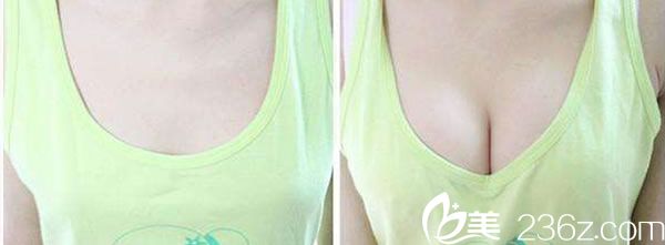 自體脂肪隆胸前后<span style=