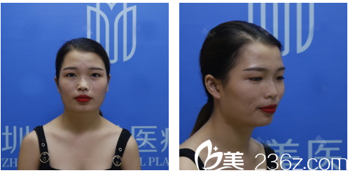 深圳美加美整形醫(yī)院雙眼皮案例術(shù)前 深圳美加美整形醫(yī)院雙眼皮案例術(shù)前