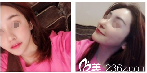 卓佑炫做內(nèi)窺鏡提升額頭術(shù)后恢復(fù)26天