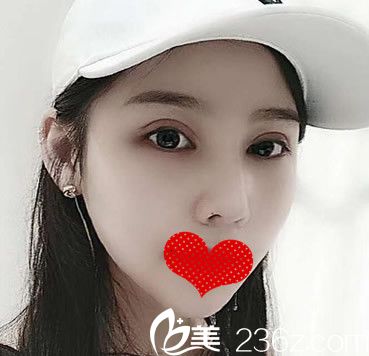 合肥安妮薇爾院長李繼銀給做肋軟骨鼻綜合+雙眼皮失敗修復15天 我從“村姑”逆襲成“女神”