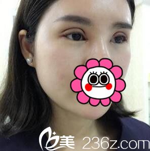 雙眼皮+開眼角術(shù)后當天照