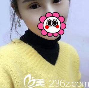 割雙眼皮+開眼角術(shù)后一周拆線