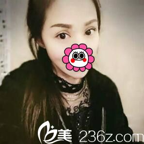 在韓國(guó)江南U&I整形外科做了雙眼皮+開(kāi)眼角后閨蜜說(shuō)我的比她的好看太多