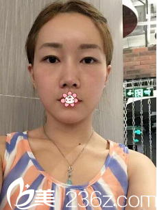 汪國應(yīng)自體脂肪面部填充術(shù)后19天 汪國應(yīng)自體脂肪面部填充術(shù)后19天