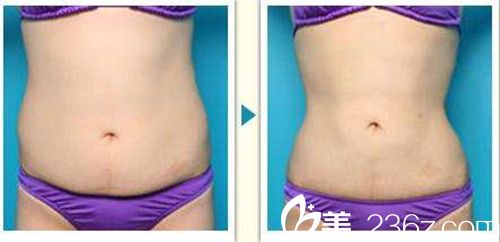 韓政憲院長吸脂瘦腰真人案例